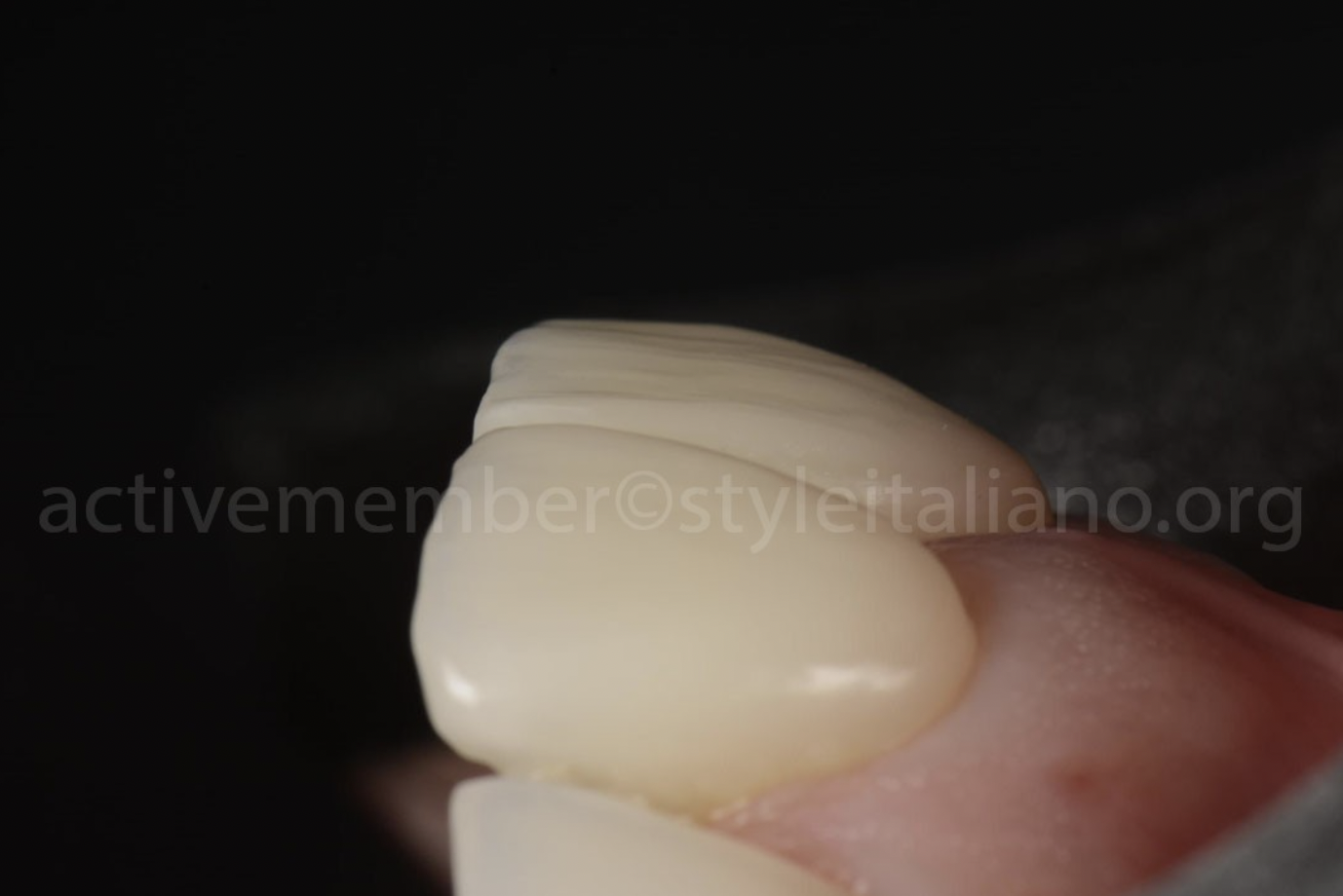 Phục hình thẩm mỹ răng cửa bằng sự kết hợp giữa Veneer và implant